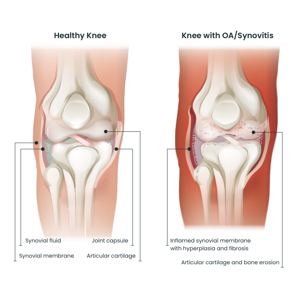 Healthy knee vs knee osteoarthritis (OA)
