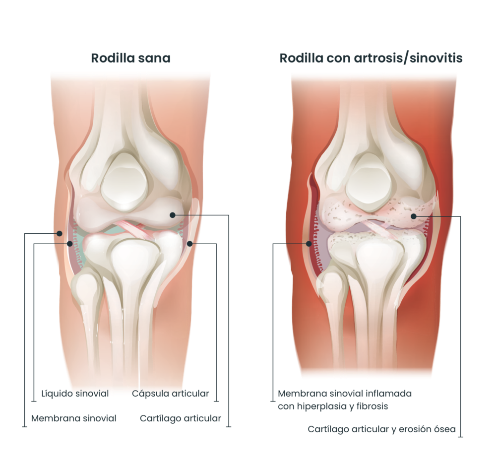 Knee compare es