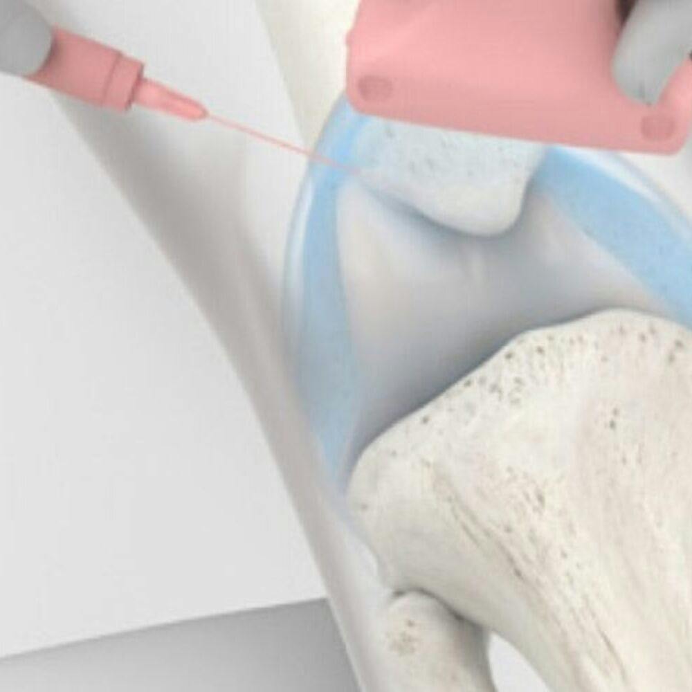 New hydrogel injection for knee osteoarthritis