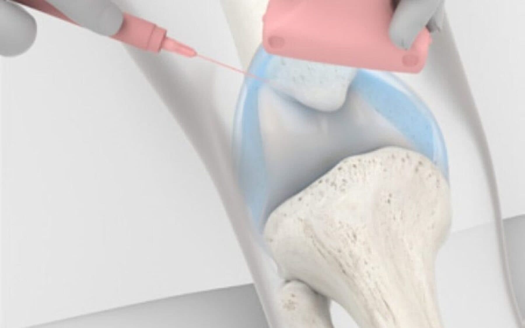Dualvis Injection New Injection For Knees Viscosupplementation Knee Injection